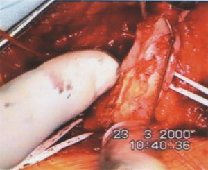 Intima pótlás thrombendarteriectomia után: Enduring