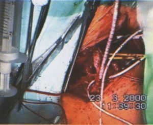 Intima pótlás thrombendarteriectomia után: Enduring