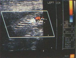Intima pótlás thrombendarteriectomia után: Enduring