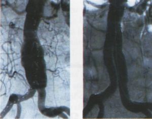 Intima pótlás thrombendarteriectomia után: Enduring