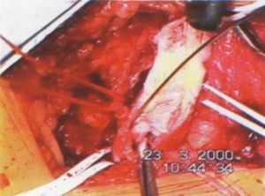 Intima pótlás thrombendarteriectomia után: Enduring