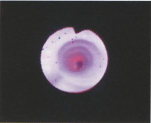 Intima pótlás thrombendarteriectomia után: Enduring