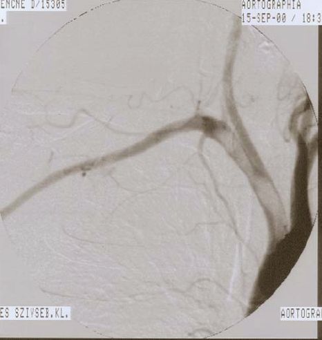 A supraaorticus artériák idiopathiás thromboemboliájának kezelése
