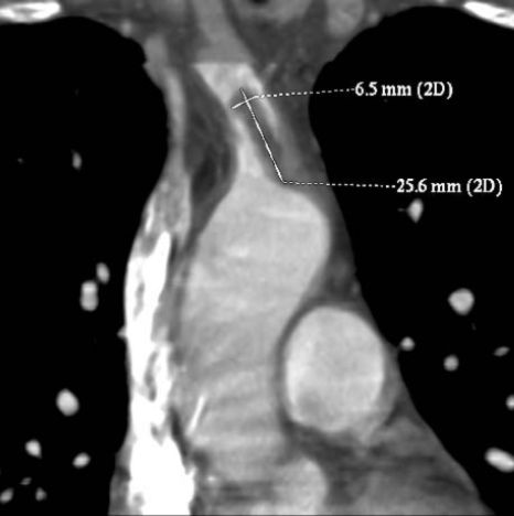 A supraaorticus artériák idiopathiás thromboemboliájának kezelése