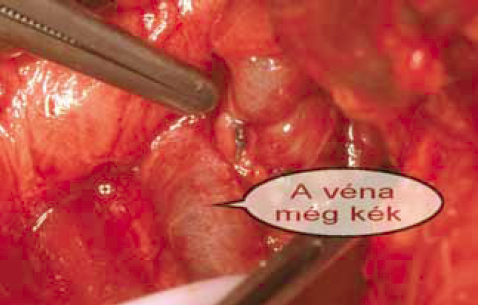 A magyarországi kísérletes és klinikai nyirok-érsebészet története, a XX. század második felében.