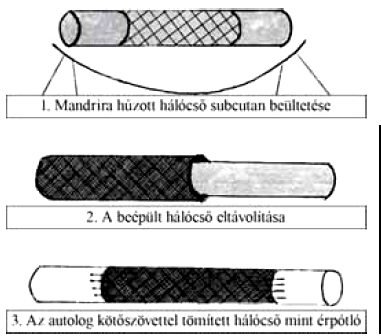 Korai érsebészeti műhelyek Magyarországon, a múlt század ötvenes-nyolcvanas éveiben IV.