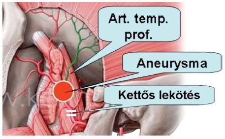 Magányos farkasok a magyar érsebészetben a homályba vesző kezdetektől Soltész koráig
