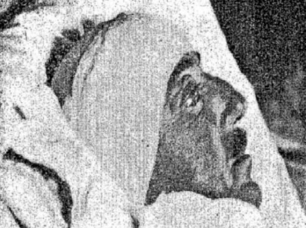 ?Magányos farkasok? a magyar érsebészetben a homályba vesző kezdetektől Soltész koráig - III.