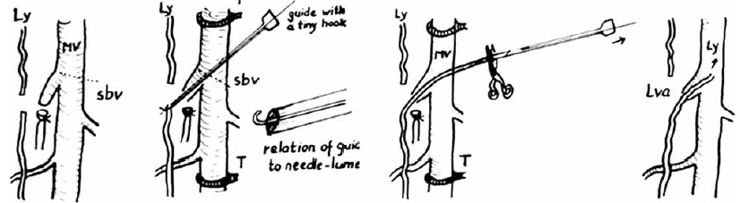 A Kett-féle behúzásos lymphangio-venosus anastomosis