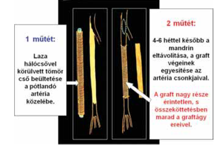 Az in situ paeformált auto-alloplastica elvi vázlata