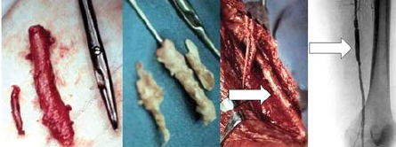 Eversiós
thrombendarteriectomia