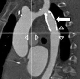 coarctatio miatt beültetett lyophilizált homograft