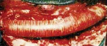 Aorta thoracalis pótlás