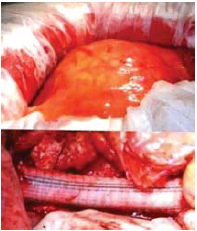Aorta abdominalis