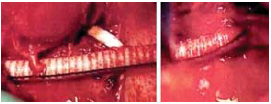 Thoraco-abdominalis aorta