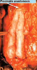 aorto-bifemoralis