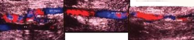 femoro-tibialis post. saphena bypass