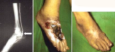 femoro-plantaris bypass