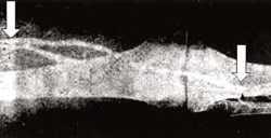 Dardik-graft femorotibialis pozicióban.