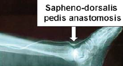 Femoro-distalis composit bypass dacron