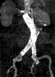 Stent graft