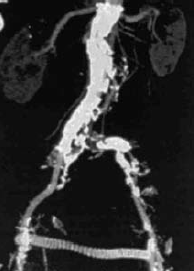 Aorto-uni-iliacalis stentgraft
