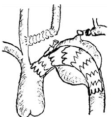 Aortaív aneurysma hybrid műtéte