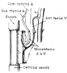 Seidenberg kísérletes oesophagus pótlása