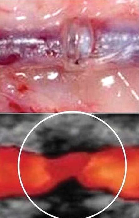 Felszívódó gyűrűs microvascularis anastomosis kéthetes explantatuma és color doppler képe (a fehér karikában látszik a gyűrű maradványának árnyéka).