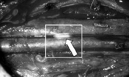Mágnes gyűrűkkel végzett, microvascularis, side to side anastomosis képe.