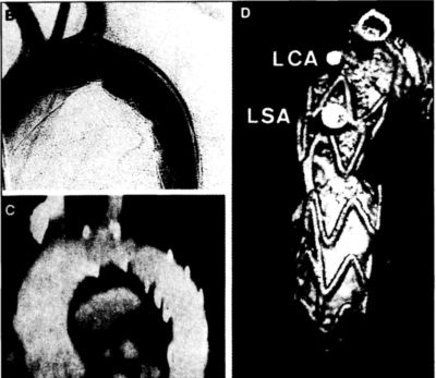 Traumás thoracalis aorta ruptura műtéti ellátása