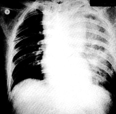 Traumás thoracalis aorta ruptura műtéti ellátása