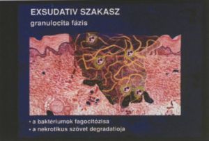 Krónikus sebek kezelése a gyógyulás különböző fázisaiban