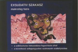 Krónikus sebek kezelése a gyógyulás különböző fázisaiban
