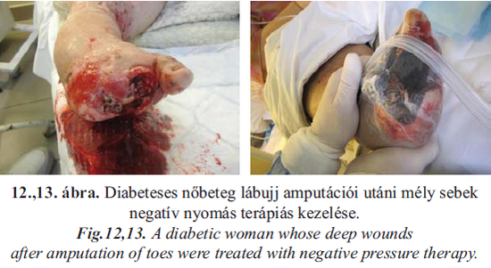 Negatívnyomású sebkezelés