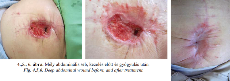 Negatívnyomású sebkezelés