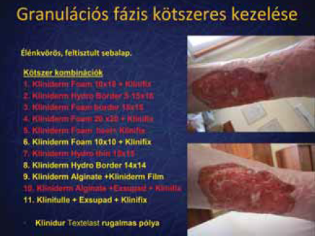 Kötszeres kezelés