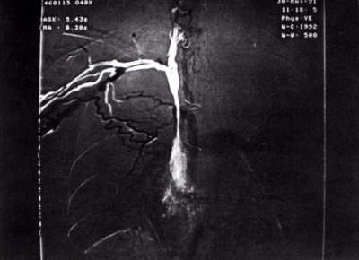 A vena cava superior syndroma érsebészeti kezelése: a 