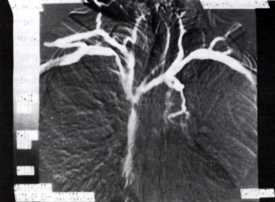 A vena cava superior syndroma érsebészeti kezelése: a 