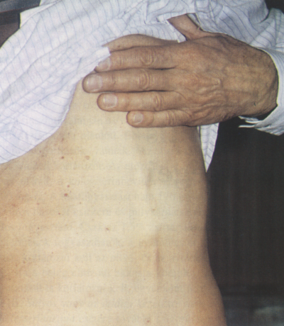A felületes phlebitis kezelési lehetősségei