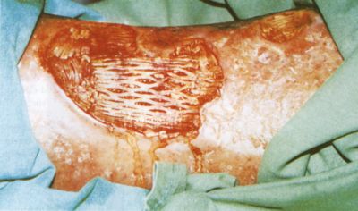 Curiosin additív kezelés ulcus cruris transzplantációja során