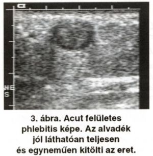 A visszerek duplex ultrahang vizsgálata