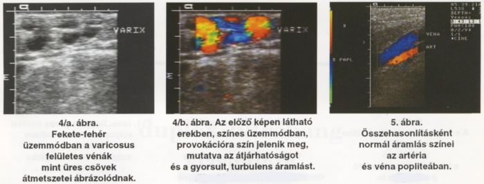 A visszerek duplex ultrahang vizsgálata