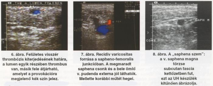 A visszerek duplex ultrahang vizsgálata