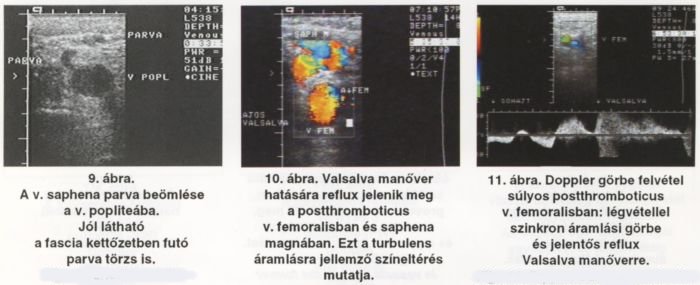 A visszerek duplex ultrahang vizsgálata