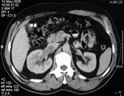 Vena cava thrombosist is okozó vesetumorok műtéti kezelése