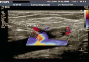 A varicositas endovascularis műtétei laserrel és rádiófrekvenciás koagulátorral