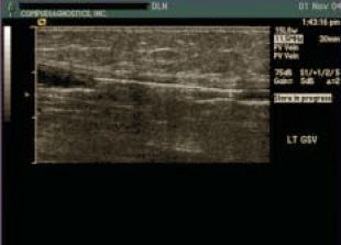 A varicositas endovascularis műtétei laserrel és rádiófrekvenciás koagulátorral