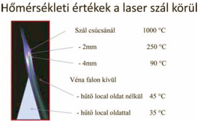  Lézeres visszérműtét újabb tapasztalatai