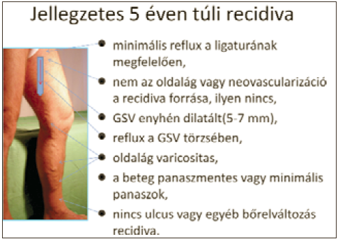 A véna saphena magna megőrzése